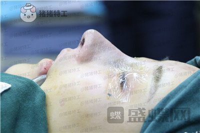 北京长虹于志宏隆鼻案例价格分享，我就是喜欢混血网红风没什么毛病