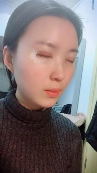 蚌埠美莱坞张迪眼部综合怎么样？价格案例分享