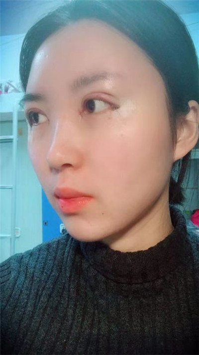 蚌埠美莱坞张迪眼部综合怎么样？价格案例分享