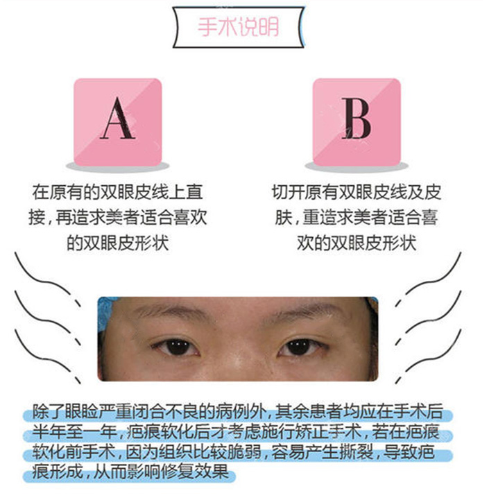 南京友谊做双眼皮修复眼角疤痕修复怎么样？