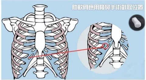 耳软骨和肋软骨隆鼻有什么区别？