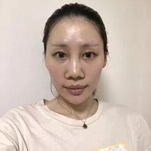 郑州元素美学鲁亚东鼻部手术怎么样？案例分享