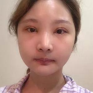 上海华美李志海下颌角＋颧骨内推＋眼部手术怎么样？案例分享