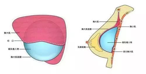 隆胸和真胸，你能区分出来？